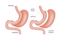 Gastrectomy