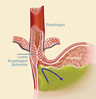 Laparoscopic Nissen Fundoplication Technique: Laparoscopic Nissen  Fundoplication, Complications