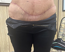 Skin Remove Surgery-1