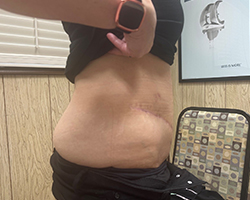 Skin Remove Surgery-2