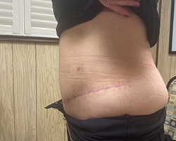 Skin Remove Surgery-3