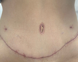 Skin Remove Surgery-5