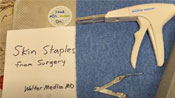Staple Removal Post Bariatric Surgery